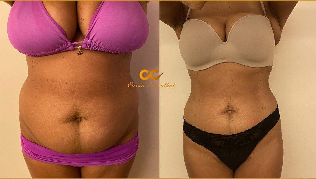 Resultado Tríade 360° — Redução abdominal frontal