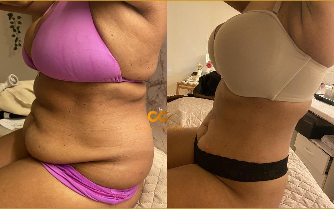 Resultado Tríade 360° — Redução abdominal lateral